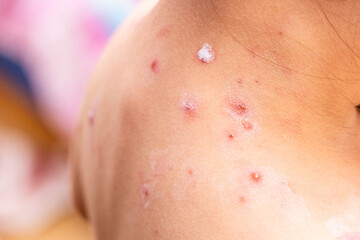 Fototapeta premium treatment of ulcers from chickenpox, varicella with medical cream