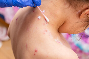 treatment of ulcers from chickenpox, varicella with medical cream