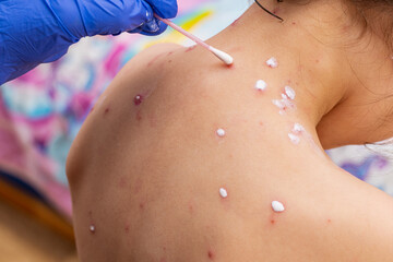 treatment of ulcers from chickenpox, varicella with medical cream