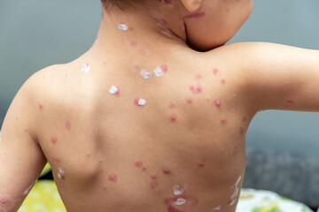 treatment of ulcers from chickenpox, varicella with medical cream on the kid skin