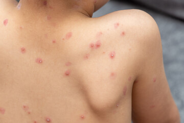 treatment of ulcers from chickenpox, varicella with medical cream on the kid skin