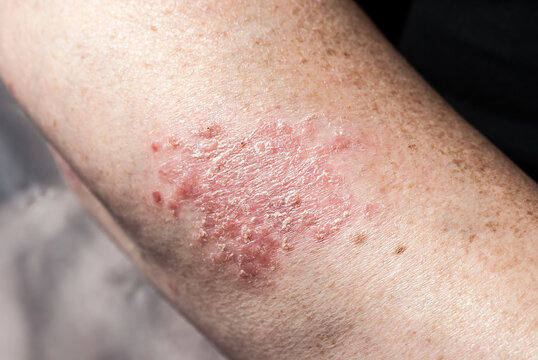 Psoriasis am Unterarm 