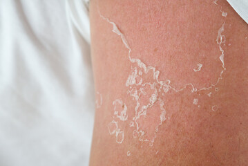 peeling of skin after burned by sunlight. not using sunscreen. sunburn of the skin