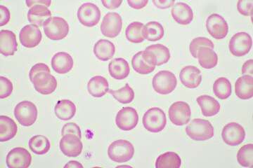 Target cells with abnormal red blood cells in blood smear, specimen from thalassemia patient, analyze by microscope 1000x