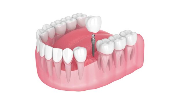 Mini dental implant placement over white background