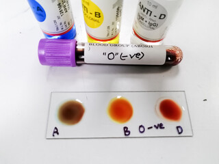Blood group testing by slide agglutination method with sample and reagent bottles,show O Negative result.