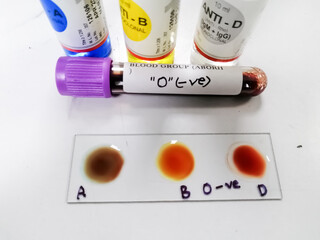 Blood group testing by slide agglutination method with sample and reagent bottles,show O Negative...