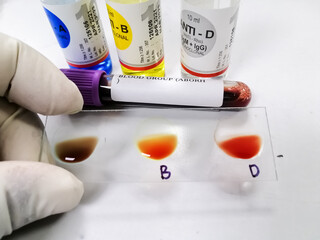 Blood group testing by slide agglutination method with sample and reagent bottles,show O Negative...