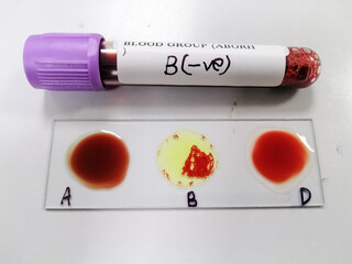 Blood group testing by slide agglutination method with sample,show result  B Negative - obrazy, fototapety, plakaty