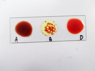 Blood group testing by slide agglutination method,show B Negative result.