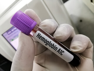 Blood sample for Hemoglobin A1c(HbA1c) test, diabetes diagnosis