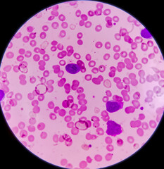 Photomicrograph of Acute Myeloblastic Leukemia (AML), Auer rods or Auer bodies present,a cancer of white blood cell,100x view