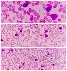 Photomicrograph of Acute Myeloid Leukemia (AML), Auer rods or Auer bodies present, One type of...