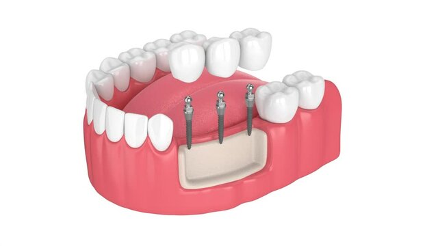 Dental bridge supported by mini dental implants over white background