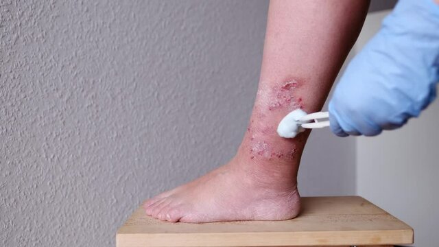 doctor, nurse, in blue gloves, heals with a medicine a wound on female leg with a medicine, medical concept, psychological aspect of self-harm