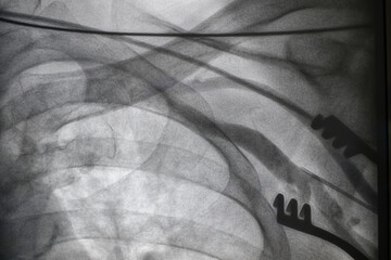 x ray image perform saphenous vein graft angiogram in patient 