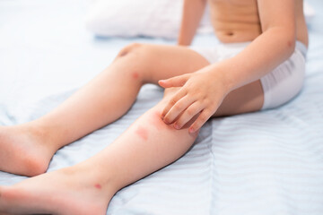 Obraz na płótnie Canvas Childrens feet allergic from mosquito bites Large mosquito bites hurt on childrens feet that sit on the bed.