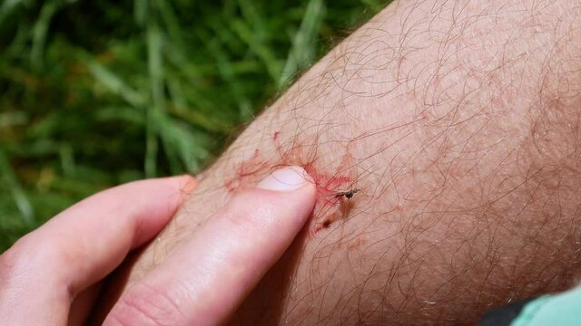Man killed Mosquito with blood on the leg. Insects bite in the summer. Dangerous nature. Itchy body.