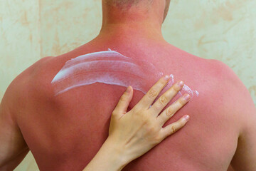 Woman's hand carefully applies healing cream to sunburned back skin of man