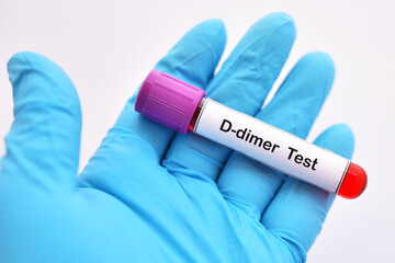 Blood sample tube for D-dimer test, diagnosis for intravascular thrombosis after COVID-19...