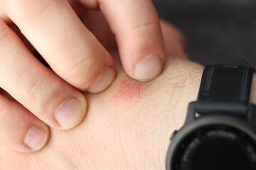 Man scratches red spot on wrist closeup