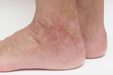 Fototapeta premium Scar on the leg from a burn after 40 years.