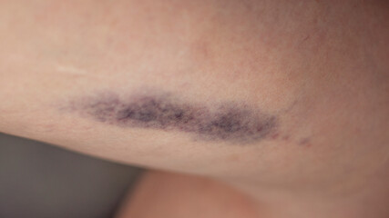 Big bruising on a woman's thigh.