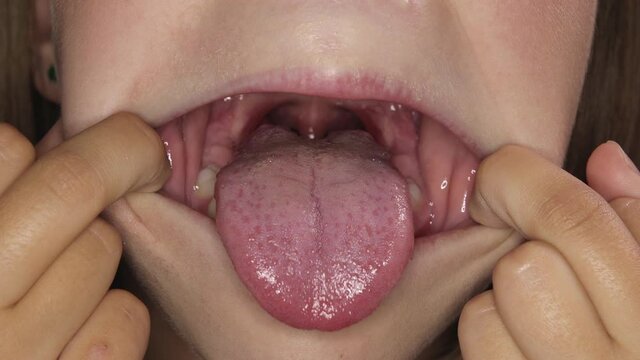 Girl at an appointment with a doctor, a jaw surgeon or an orthodontist. Child opens his mouth wide and sticks out his tongue for inspection. Extreme close-up