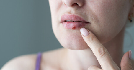 The woman with a virus herpes on lips - Powered by Adobe