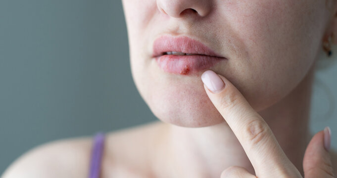 The woman with a virus herpes on lips