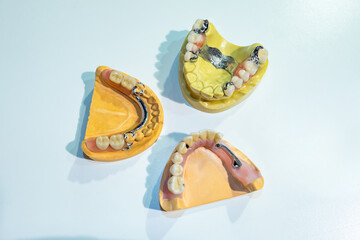 Human jaw prosthesis. Dentures with metal plates. Several options for dentures. Orthodontic dentures on a white background. Treatment of dental diseases. Dentist or orthodontists visual material