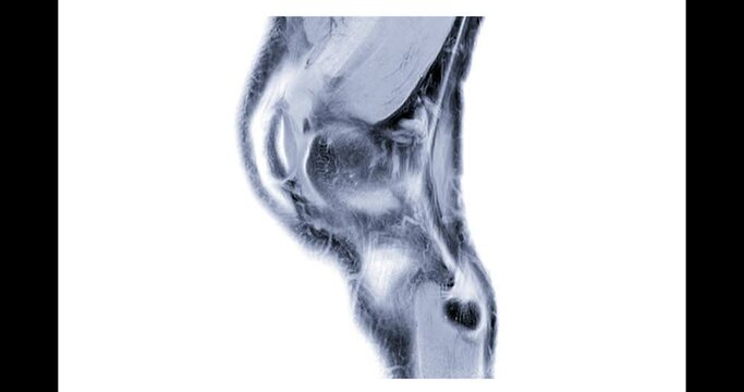 MRI knee or Magnetic resonance imaging of knee joint sagittal  for diagnosis Anterior cruciate ligament (ACL) tears