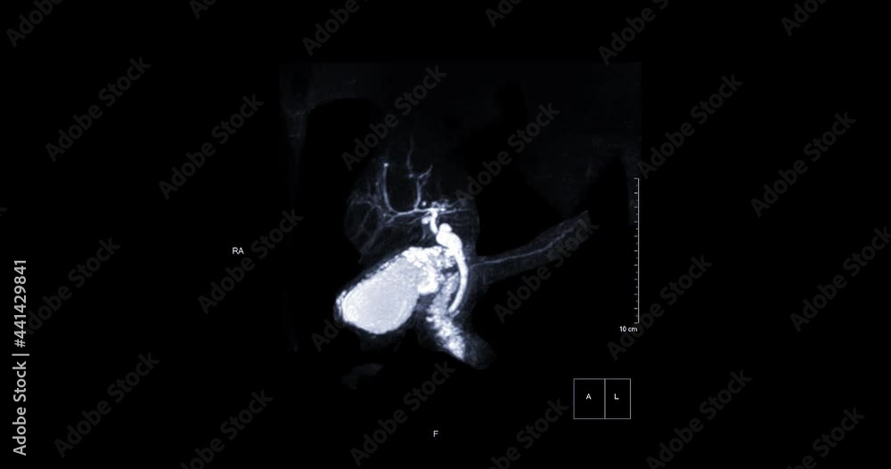 Poster mrcp or magnetic resonance cholangiopancreatography 3d mip view showing visualize the biliary tract 