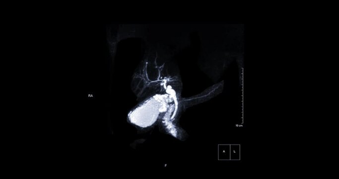 MRCP or Magnetic resonance cholangiopancreatography 3D MIP view showing visualize the biliary tract and pancreatic ducts .