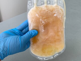 hand of a doctor or nurse holding a bag of fresh frozen blood storage plasma in a blood bank...