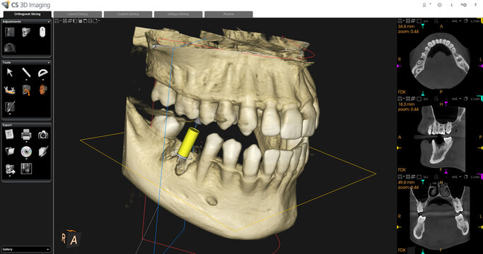 Dental CBCT Image