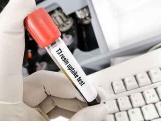 Blood sample tube for T3 resin uptake(T3RU) test,It measures the binding capacity of a hormone called thyroxin-binding globulin (TBG)