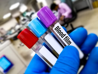 Biochemist holds Blood sample in a lavender tube for Blood Film testing in the hematology...