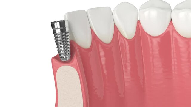 Lower jaw with dental implant installation over white background