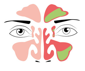 Sinusitis medical treatment. Nasal sinus. Healthy and inflammation sinus. Nasal diseases. Sinusitis, sinus infection diagnosis medical infographic design. Vector Eps.8
