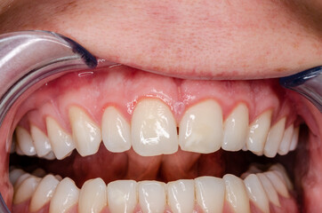distinct gingivitis at frontal teeth, vessel growth at the gingival margin