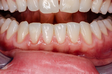 distinct gingivitis at frontal teeth, vessel growth at the gingival margin