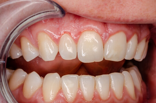 distinct gingivitis at frontal teeth, vessel growth at the gingival margin
