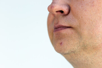 Fototapeta premium Male face with pimples on nose and chin close up.