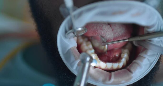 Close-up an African American male patient with an open mouth with optragate is having teeth cleaning by using a dental brash, mirror, saliva ejector.