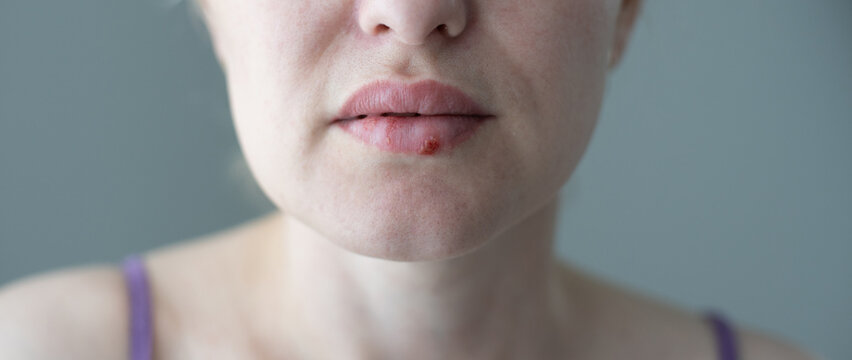 The woman with a virus herpes on lips