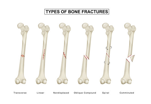 Understanding the Different Types of Bone Fractures
