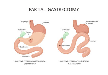 Partial gastrectomy. Stomach cancer, tumor - obrazy, fototapety, plakaty