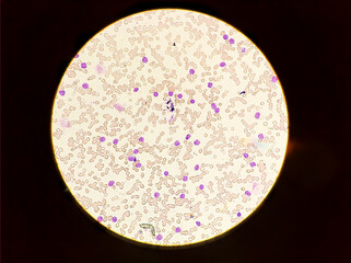 Blood smear under microscopy showing on Adult acute myeloid leukemia (AML) is a type of...