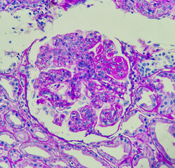 Photo of lupus nephritis, showing wire loop and hyaline thrombi, PAS stain, magnification 400x,...